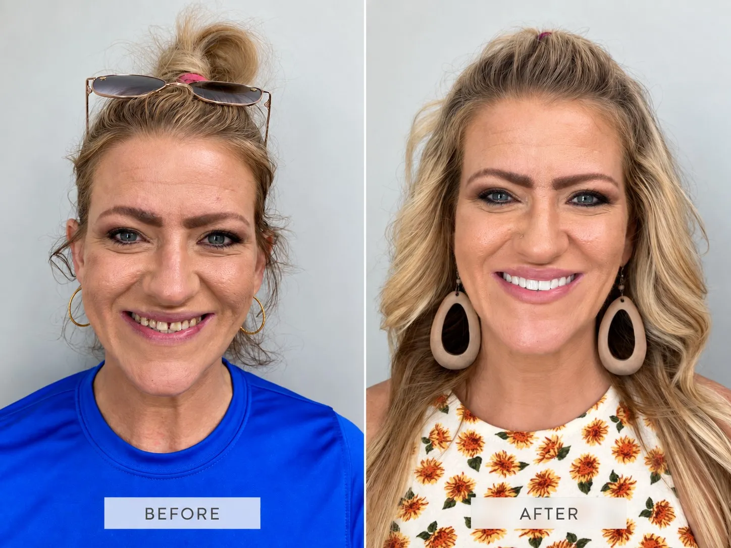 Actual Little Mountain Dentistry patient smile after treatment