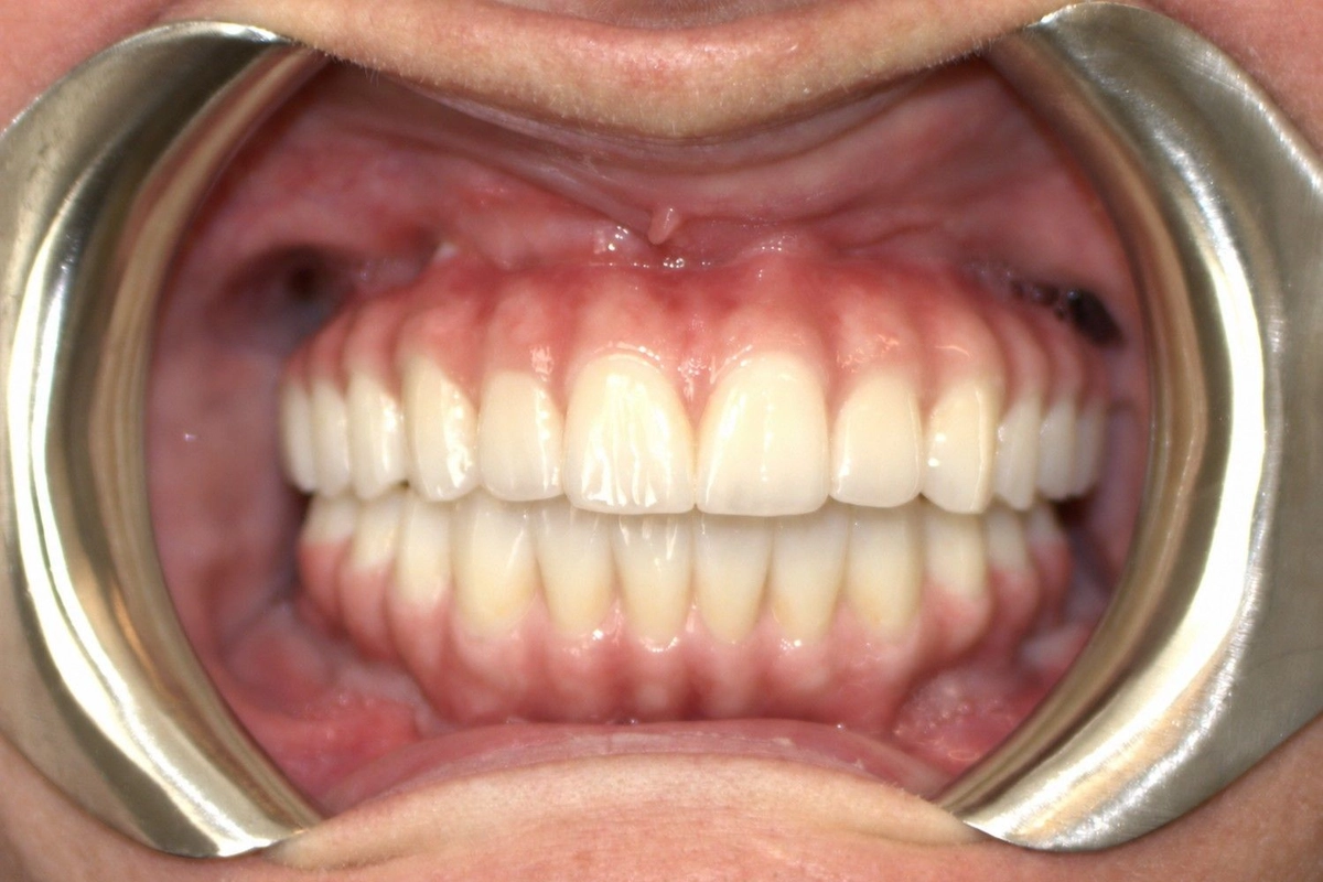 Full-Arch Dental Implants